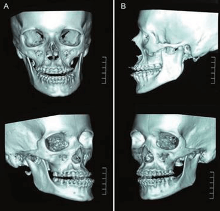 Fig 3. Tomografía computarizada de cara con reconstrucción 3D. Tomado por: (Fernando Alarcón, Cristina Zambrano. et al. 2019)