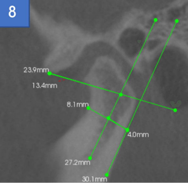 Fig 5. Imagen de fotografía CBCT que muestra una vista sagital de la relación espacial del cóndilo. Tomado por: (Marcelo Matos, Krishna Burde. et al. 2021)