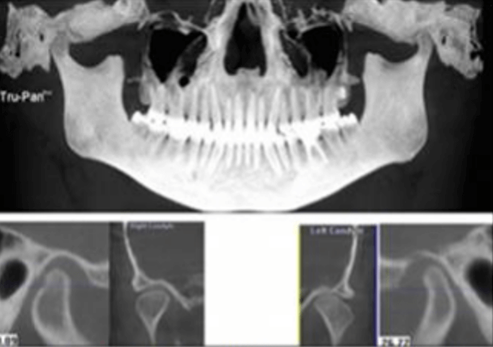 Fig 6. Toma de imagen con CBCT revela superficies óseas irregulares. Extraído de: Journal of Advanced Clinical and Research Insights (2019) 