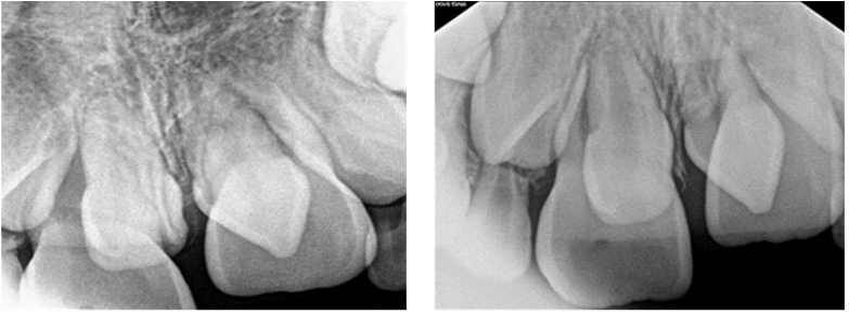 Figura 2. Radiografía periapical donde se observan ambos dientes supernumerarios.