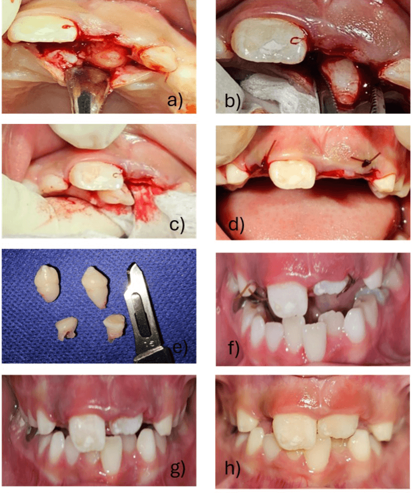 Figura 3. a) Localización de supernumerarios. b) Extracción del supernumerario izquierdo, c) Extracción del supernumerario derecho. d) Área después de la incisión quirúrgica. e) Dientes extraídos. f) Una semana postcirugía. g) Quince días postcirugía. h) Un mes postcirugía.