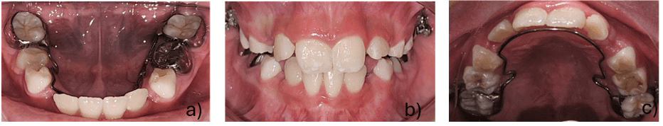 Figura 4. Vista oclusal de arcada inferior con arco lingual. b) Vista frontal en oclusal. c) Vista oclusal de arcada superior con arco lingual superior.