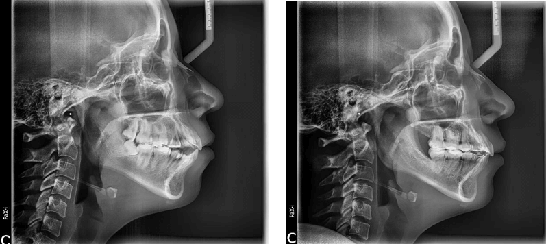 Fig.1  Rx  lateral de  cráneo inicio final (Fuente  propia CESO)