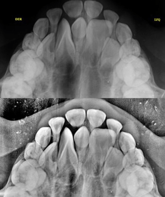 Radiografía Oclusal