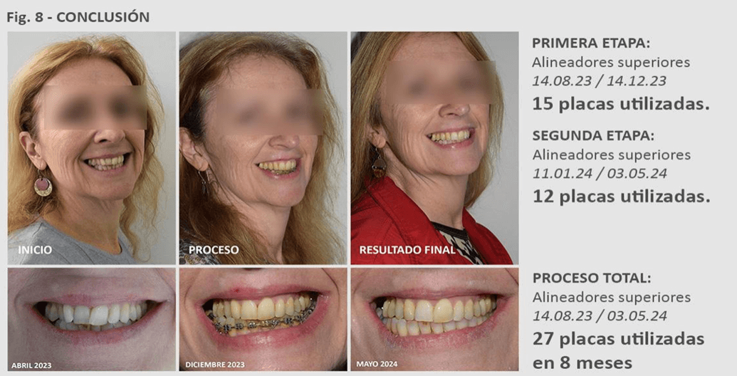 Figura A8 Imágenes de sonrisa inicio, final de la primera etapa y segunda etapa finalización del tratamiento de ortodoncia. Fuente: Elaboración propia.