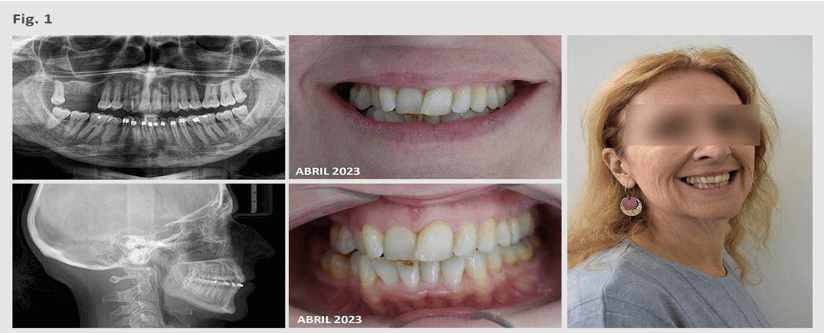 Figura A1 Inicio del tratamiento. Radiografía panorámica, telerradiografía de perfil, y fotografía del rostro con sonrisa y frontal de la boca. Fuente: Elaboración propia.