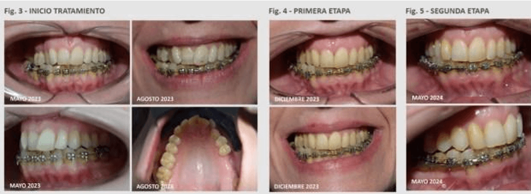 Figura A3, A4 y A5 Evolución fotográfica de inicio, finalizaciones de cada etapa: Etapa 1 y Etapa 2. Fuente: Elaboración propia.