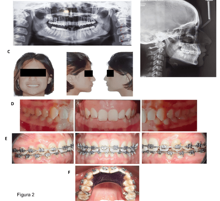 Figura 2. Caso clínico 1, paciente femenino de 18 años. Radiografías diagnósticas, A) ortopantomografía. B) lateral de cráneo. Fotografías clínicas, C) frontal, lateral derecha y lateral izquierda. Fotografías intraorales, D) lateral derecha, frontal y lateral izquierda, antes tratamiento, E) lateral derecha, frontal y lateral izquierda después de un año de tratamiento, F) dispositivo GoMo cementado.