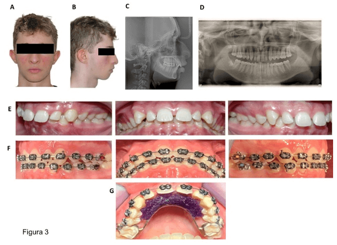 Figura 3. Caso clínico 2, paciente masculino de 18 años. Fotografías clínicas, A) frontal. B) lateral. Radiografías diagnósticas, C) lateral de cráneo, D) ortopantomografía. Fotografías intraorales, E) lateral izquierda, frontal y lateral derecha, antes del tratamiento, F) radiografías lateral izquierda, frontal y derecha, 3 meses después del tratamiento con el dispositivo GoMo. G) GoMo cementado en maxilar.